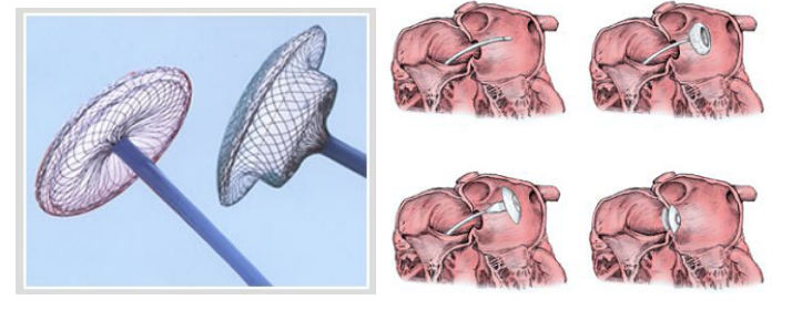 Gambar Amplatzer Septal Occluder (ASO) (kiri), dan ilustrasi pemasangan ASO pada ASD (kanan)