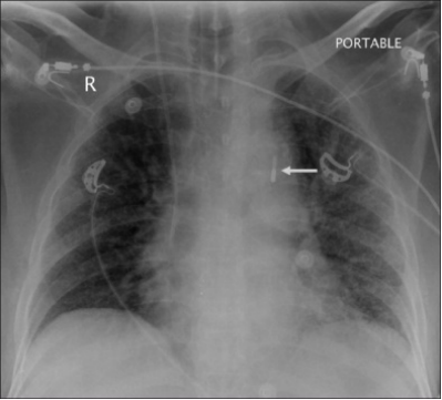 Foto Roentgen Thorax 