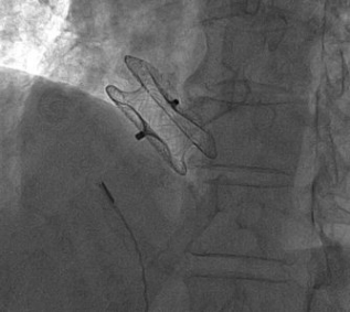 Gambar ASO device terpasang pada ASD