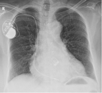 Gambar X Foto Thorax dengan Permanent Pacemaker