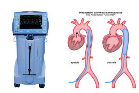 Gambar Intra-aortic Balloon Pump