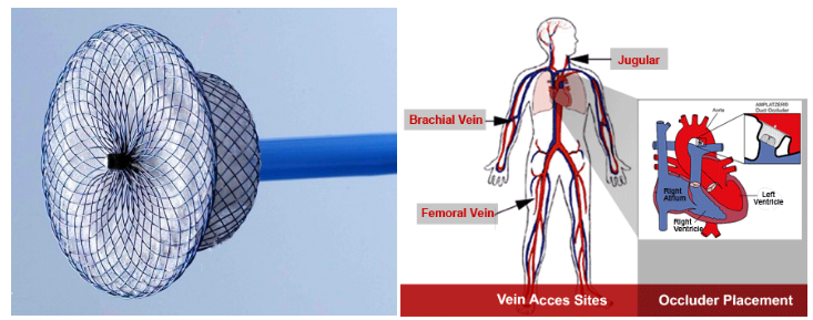 Gambar kiri adalah Amplatzer Ductal Occluder device, gambar kanan adalah ilustrasi pemasangan ADO.