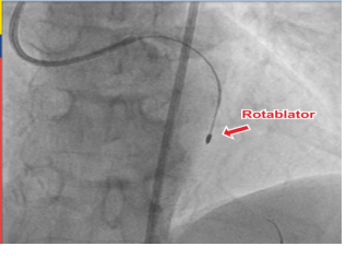 ROTALBLATOR